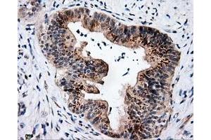 Immunohistochemical staining of paraffin-embedded Adenocarcinoma of colon tissue using anti-SIL1 mouse monoclonal antibody.
