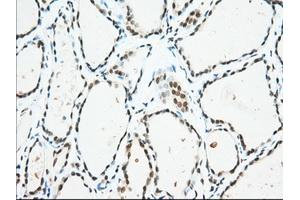 Immunohistochemical staining of paraffin-embedded Adenocarcinoma of Human colon tissue using anti-USP5 mouse monoclonal antibody. (USP5 antibody)