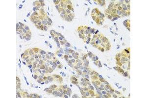 Immunohistochemistry of paraffin-embedded Human breast cancer using RFC4 Polyclonal Antibody at dilution of 1:100 (40x lens).