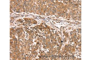 Immunohistochemistry of Human lung cancer using PDLIM4 Polyclonal Antibody at dilution of 1:30