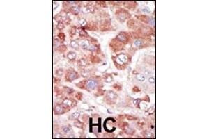 Formalin-fixed and paraffin-embedded human cancer tissue reacted with the primary antibody, which was peroxidase-conjugated to the secondary antibody, followed by AEC staining. (GRK7 antibody  (C-Term))