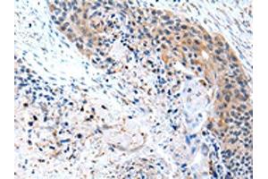 The image on the left is immunohistochemistry of paraffin-embedded Human esophagus cancer tissue using ABIN7190229(CFC1 Antibody) at dilution 1/20, on the right is treated with synthetic peptide. (CFC1 antibody)
