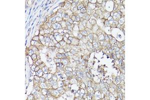 Immunohistochemistry of paraffin-embedded human breast cancer using MCT4/SLC16 Rabbit pAb (ABIN6129472, ABIN6147859, ABIN6147860 and ABIN6214836) at dilution of 1:100 (40x lens). (SLC16A3 antibody  (AA 371-465))