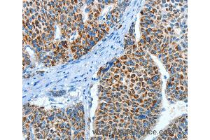Immunohistochemistry of Human liver cancer using ALDH4A1 Polyclonal Antibody at dilution of 1:45 (ALDH4A1 antibody)