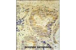 FB Antibody (Center) (ABIN651921 and ABIN2840456) immunohistochemistry analysis in formalin fixed and paraffin embedded human prostate carcinoma followed by peroxidase conjugation of the secondary antibody and DAB staining. (FAM105B antibody  (AA 99-128))