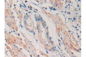 DAB staining on IHC-P; Samples: Human Stomach cancer Tissue (IGLL1 antibody  (AA 29-201))
