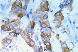 Immunohistochemistry (IHC) analyzes of p-IGF1R antibody in paraffin-embedded human lung adenocarcinoma tissue. (IGF1R antibody  (pTyr980))