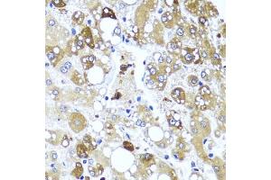 Immunohistochemistry of paraffin-embedded human liver damage using IL4 antibody (ABIN6128137, ABIN6142396, ABIN6142397 and ABIN6221290) at dilution of 1:100 (40x lens). (IL-4 antibody  (AA 25-153))