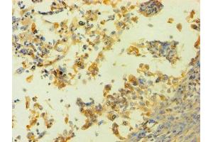 Immunohistochemistry of paraffin-embedded human cervical cancer using ABIN7155116 at dilution of 1:100 (HNRNPH1 antibody  (AA 2-449))