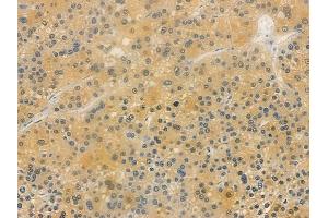 ABIN7096367 and ABIN7100430 at 1/100 staining human hepatocellular carcinoma by IHC-P.