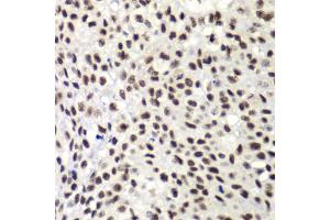 Immunohistochemistry of paraffin-embedded human lung cancer using NELFE antibody.