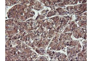 Immunohistochemical staining of paraffin-embedded Carcinoma of Human liver tissue using anti-HDHD1 mouse monoclonal antibody. (HDHD1 antibody)