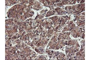 Immunohistochemical staining of paraffin-embedded Carcinoma of Human liver tissue using anti-HDHD1 mouse monoclonal antibody.