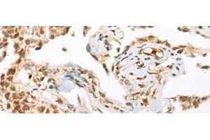 Immunohistochemistry of paraffin-embedded Human ovarian cancer tissue using ATN1 Polyclonal Antibody at dilution of 1:50(x200) (Atrophin 1 antibody)