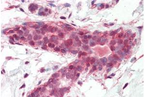 Human Breast (formalin-fixed, paraffin-embedded) stained with BRAP antibody ABIN462090 followed by biotinylated goat anti-rabbit IgG secondary antibody ABIN481713, alkaline phosphatase-streptavidin and chromogen. (BRAP antibody  (AA 67-79))