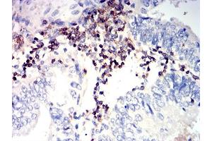 Immunohistochemical analysis of paraffin-embedded endometrial cancer tissues using CD352 mouse mAb with DAB staining.