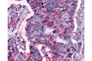 Anti-FZD5 / Frizzled 5 antibody IHC of human Lung, Non-Small Cell Carcinoma. (FZD5 antibody  (Cytoplasmic Domain))