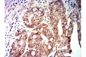 Immunohistochemical analysis of paraffin-embedded rectal cancer tissues using CDX2 mouse mAb with DAB staining. (CDX2 antibody  (AA 1-180))