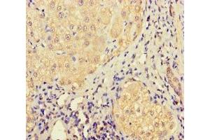 Immunohistochemistry of paraffin-embedded human liver cancer using ABIN7158316 at dilution of 1:100 (LHFPL1 antibody  (AA 21-85))