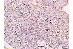 Formalin-fixed and paraffin embedded human colon carcinoma tissue labeled with Anti BACH1/BRIP1 Polyclonal Antibody,Unconjugated (ABIN753718) at 1:200 followed by conjugation to the secondary antibody and DAB staining. (BRIP1 antibody)