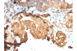 Formalin-fixed, paraffin-embedded human Breast Carcinoma stained with GRP94 Recombinant Rabbit Monoclonal Antibody (HSP90B1/3168R).