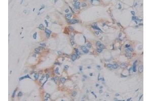 Detection of IL2 in Human Bile duct cancer Tissue using Monoclonal Antibody to Interleukin 2 (IL2) (IL-2 antibody  (AA 21-153))