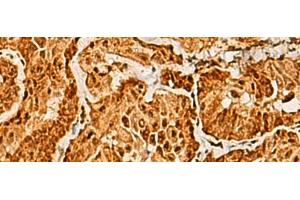 Immunohistochemistry of paraffin-embedded Human thyroid cancer tissue using SAP30BP Polyclonal Antibody at dilution of 1:40(x200) (SAP30BP antibody)