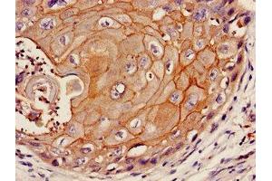 Immunohistochemistry of paraffin-embedded human cervical cancer using ABIN7157166 at dilution of 1:100