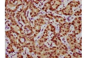 IHC image of nphHU diluted at 1:10 and staining in paraffin-embedded human liver cancer performed on a Leica BondTM system. (CENPA antibody)