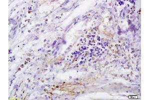 Formalin-fixed and paraffin embedded human cervical carcinoma labeled with Anti-CD146/MCAM Polyclonal Antibody, Unconjugated (ABIN732143) at 1:200 followed by conjugation to the secondary antibody and DAB staining