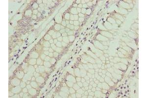 Immunohistochemistry of paraffin-embedded human colon cancer using ABIN7144195 at dilution of 1:100 (ASB7 antibody  (AA 1-274))