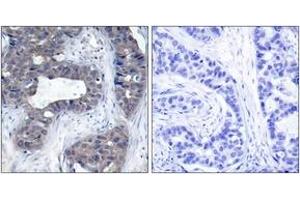 Immunohistochemistry analysis of paraffin-embedded human breast carcinoma tissue, using IRS-1 (Ab-307) Antibody. (IRS1 antibody  (AA 274-323))