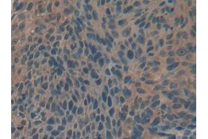 IHC-P analysis of Human Esophagus cancer Tissue, with DAB staining. (Biglycan antibody  (AA 243-369))