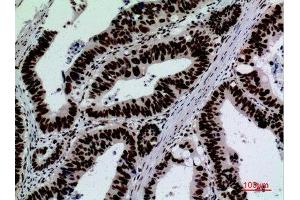 Immunohistochemistry (IHC) analysis of paraffin-embedded Human Colon Cancer, antibody was diluted at 1:100. (SIGLEC7 antibody  (Internal Region))