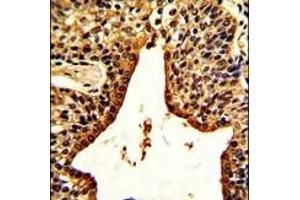 Formalin-fixed and paraffin-embedded human prostate carcinoma with VIP Antibody (C-term), which was peroxidase-conjugated to the secondary antibody, followed by DAB staining. (Vip antibody  (C-Term))