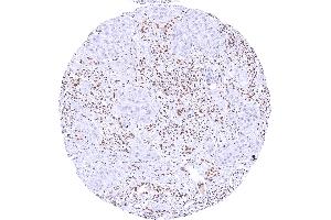 Invasive urothelial carcinoma of the urinary bladder with complete absence of KDM6 staining in tumor cells