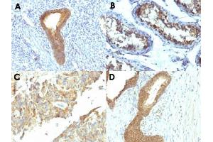 Immunohistochemical staining (Formalin-fixed paraffin-embedded sections) of human endometrial carcinoma (A), human testicular carcinoma (B), human ovarian carcinoma (C) and human colon carcinoma (D) with ALPL monoclonal antibody, clone ALPL/597 .
