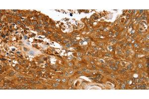Immunohistochemistry of paraffin-embedded Human esophagus cancer tissue using ABCC8 Polyclonal Antibody at dilution 1:40 (ABCC8 antibody)