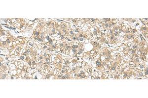 Immunohistochemistry of paraffin-embedded Human liver cancer tissue using PAPSS2 Polyclonal Antibody at dilution of 1:95(x200) (PAPSS2 antibody)