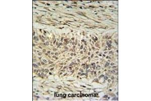 DDX23 Antibody (Center) (ABIN651059 and ABIN2840053) IHC analysis in formalin fixed and paraffin embedded lung carcinoma followed by peroxidase conjugation of the secondary antibody and DAB staining. (DDX23 antibody  (AA 248-277))