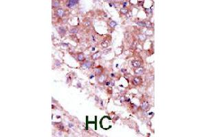 Formalin-fixed and paraffin-embedded human hepatocellular carcinoma tissue reacted with STK33 polyclonal antibody  , which was peroxidase-conjugated to the secondary antibody, followed by DAB staining. (STK33 antibody  (C-Term))