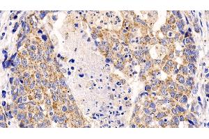 Detection of MCL1 in Human Lymphoma Tissue using Polyclonal Antibody to Induced Myeloid Leukemia Cell Differentiation Protein Mcl-1 (MCL1)