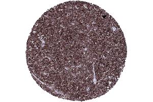 B cell chronic lymphatic leukemia B CLL composed of strongly CD23 positive tumor cells (FCER2 antibody  (AA 48-321))