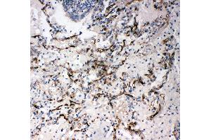 Anti-CD34 antibody, IHC(P) IHC(P): Human Lung Cancer Tissue (CD34 antibody  (C-Term))