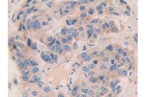 Detection of CNTN4 in Human Breast cancer Tissue using Polyclonal Antibody to Contactin 4 (CNTN4) (Contactin 4 antibody  (AA 731-980))
