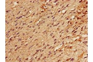 Immunohistochemistry of paraffin-embedded human glioma using ABIN7164177 at dilution of 1:100 (RBM22 antibody  (AA 2-250))