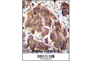 GLMN Antibody immunohistochemistry analysis in formalin fixed and paraffin embedded human bladder carcinoma followed by peroxidase conjugation of the secondary antibody and DAB staining. (GLMN antibody  (C-Term))