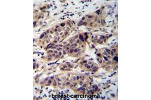 WDR42C Antibody (N-term) immunohistochemistry analysis in formalin fixed and paraffin embedded human breast carcinoma followed by peroxidase conjugation of the secondary antibody and DAB staining. (DCAF8L2 antibody  (N-Term))