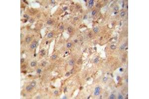 NEU4 antibody immunohistochemistry analysis in formalin fixed and paraffin embedded human hepatocarcinoma. (Sialidase 4 antibody  (AA 423-452))