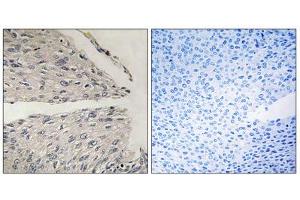 Immunohistochemistry analysis of paraffin-embedded human cervix carcinoma tissue using CIDEB antibody. (CIDEB antibody  (Internal Region))
